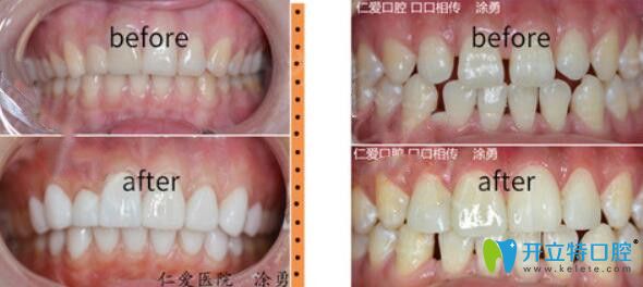 屬于<!--<i data=20240703-sp></i>-->口腔的超薄瓷貼面修復(fù)牙齒案例