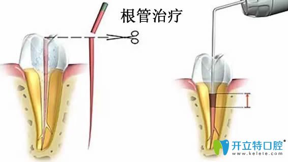 王化力醫(yī)生科普牙痛為何要做根管治療