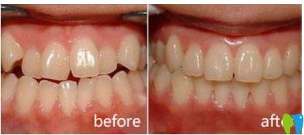 北京維樂口腔牙齒不齊矯正案例圖