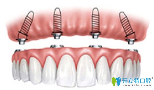 維恩口腔ALL-on-4種植技術(shù)