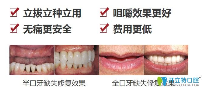 中諾口腔立得用種植牙優(yōu)勢(shì)