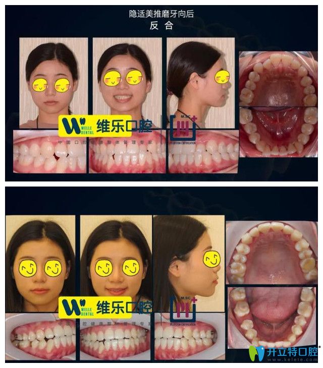 維爾口腔反頜導(dǎo)致牙縫增大案例圖