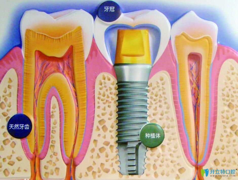 人工種植牙什么材料好?不同的材料的種植牙價格各是多少?