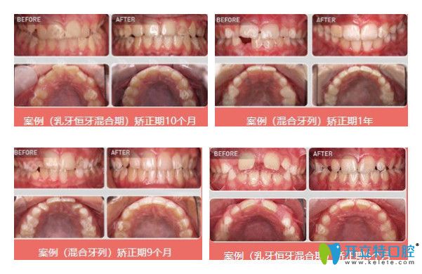 維樂口腔兒童牙齒矯正案例圖示