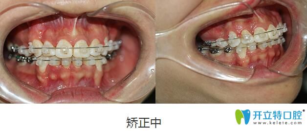 在深圳格倫菲爾口腔福田總店先后做了齙牙矯正和冷光美白