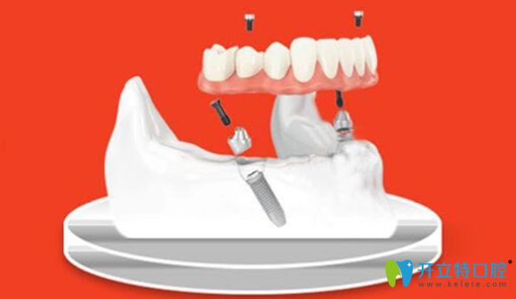  新鄉(xiāng)拜博口腔2顆種植體就可修復(fù)半口牙