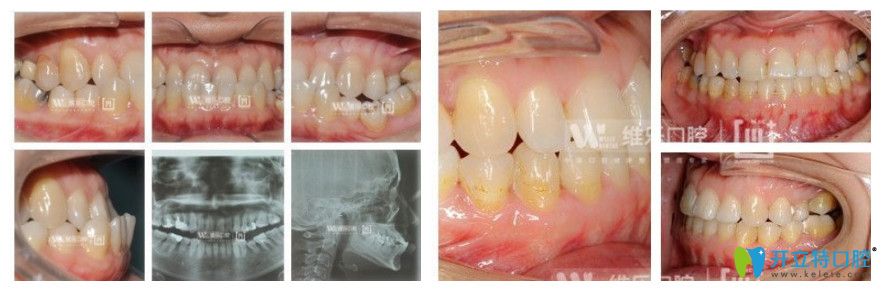 維樂(lè)口腔8歲女性地包天矯正前后對(duì)比圖