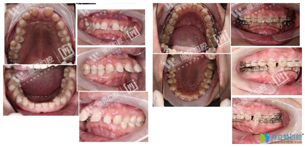 北京維樂口腔不知道去北京哪里做牙齒矯正不妨看下維樂口腔譚暉的案例