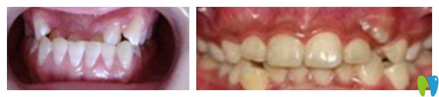 兒童常見(jiàn)的牙齒畸形圖