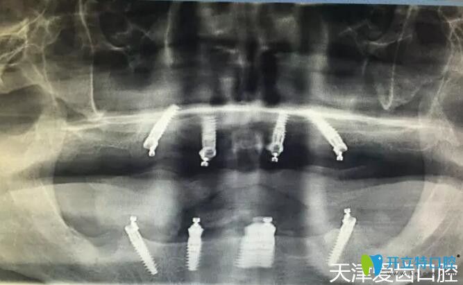 我在天津愛齒口腔做allon4全口種植牙術(shù)后CT片