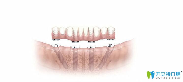 All-on-4即刻種植牙