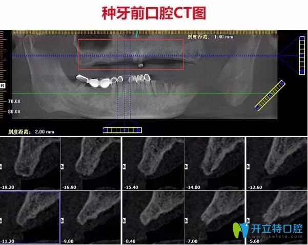 不了解珠海種牙哪家醫(yī)院好，不如看看仁愛口腔即刻種植牙