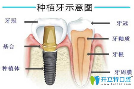 重慶美奧口腔正規(guī)可靠嗎?我做完種植牙來評(píng)價(jià)醫(yī)院收費(fèi)怎樣