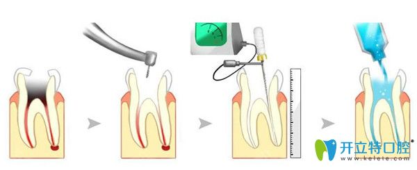 根管治療過程示意圖