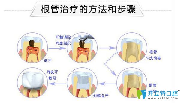 根管治療步驟