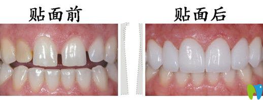 牙齒貼面前后對(duì)比