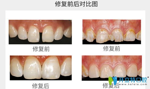 牙齒貼面修復(fù)前后對比圖