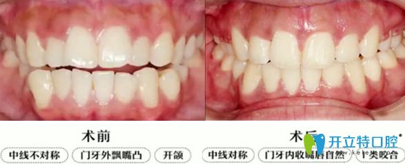 上排門牙外凸開頜隱適美牙套矯正2年畢業(yè)啦,大波對比圖來襲