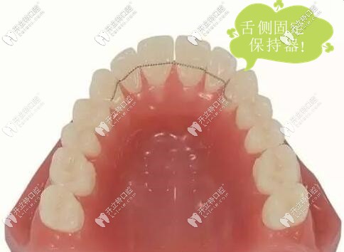 舌側(cè)固定保持器