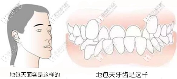 我家孩子使用兒童mrc矯正器經(jīng)歷,3個(gè)月效果還是蠻驚人的