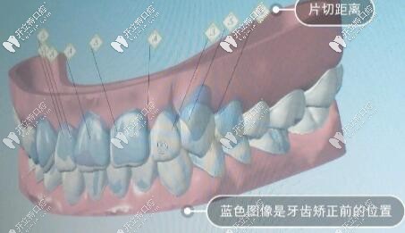 牙齒矯正3d模型