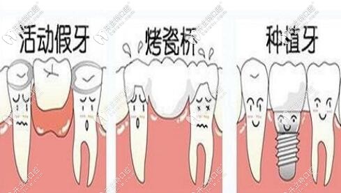 活動假牙烤瓷牙種植牙哪個好