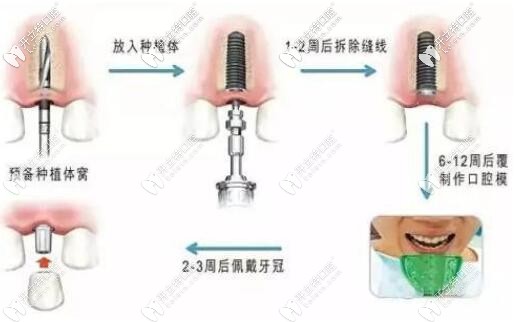 種植牙的過程