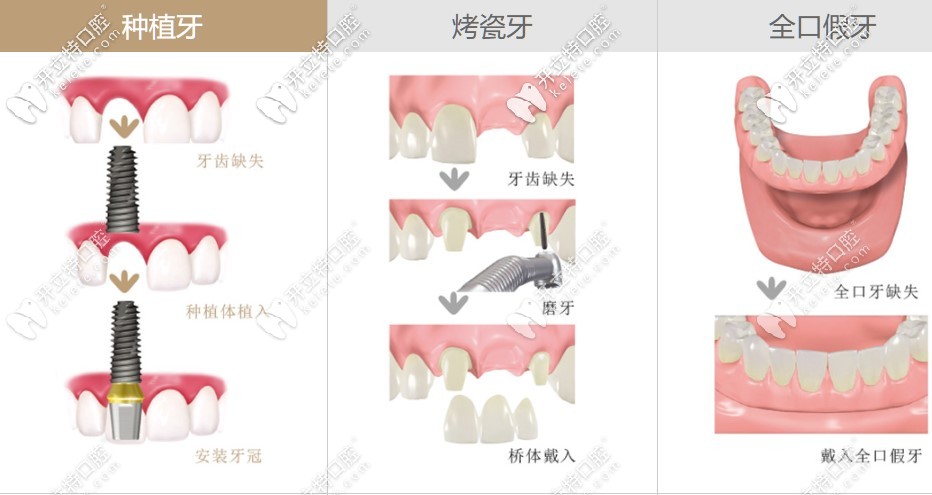 種植牙和活動(dòng)假牙從價(jià)格及壽命來進(jìn)行對比