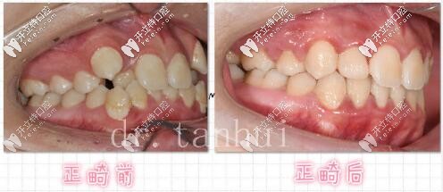 北京維樂口腔正畸案例