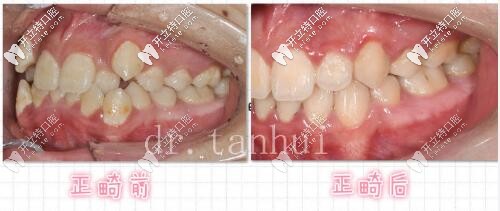 北京維樂口腔正畸案例 側(cè)面