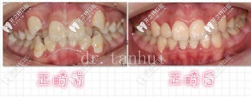 北京維樂口腔骨性一類錯(cuò)頜畸形矯治案例