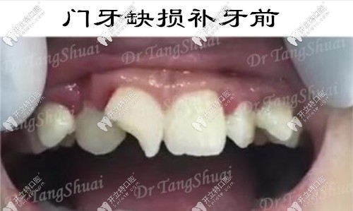 兒子門(mén)牙缺損一個(gè)角,用意大利美塑樹(shù)脂補(bǔ)的牙還挺耐磨