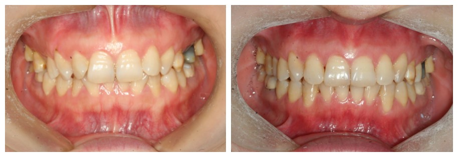 隱形牙套矯正深覆合沒效果?她做時代天使不到2年告別了嘴凸