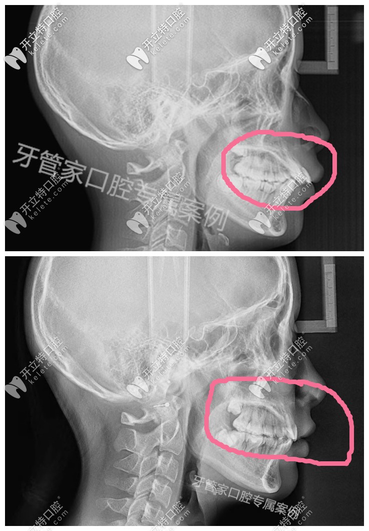 骨性齙牙帶牙套有效果，下牙套后我的骨性牙齒內(nèi)收了6毫米