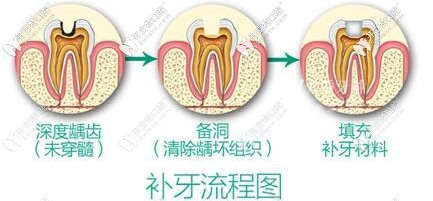 兒童補牙的流程圖