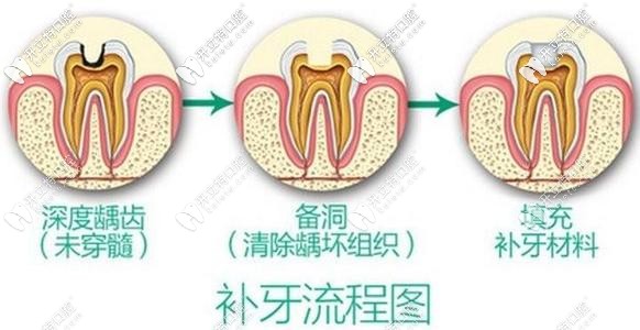 蛀牙別拖久喲!偷偷告訴你杭州做3M樹脂補牙的價格在這！