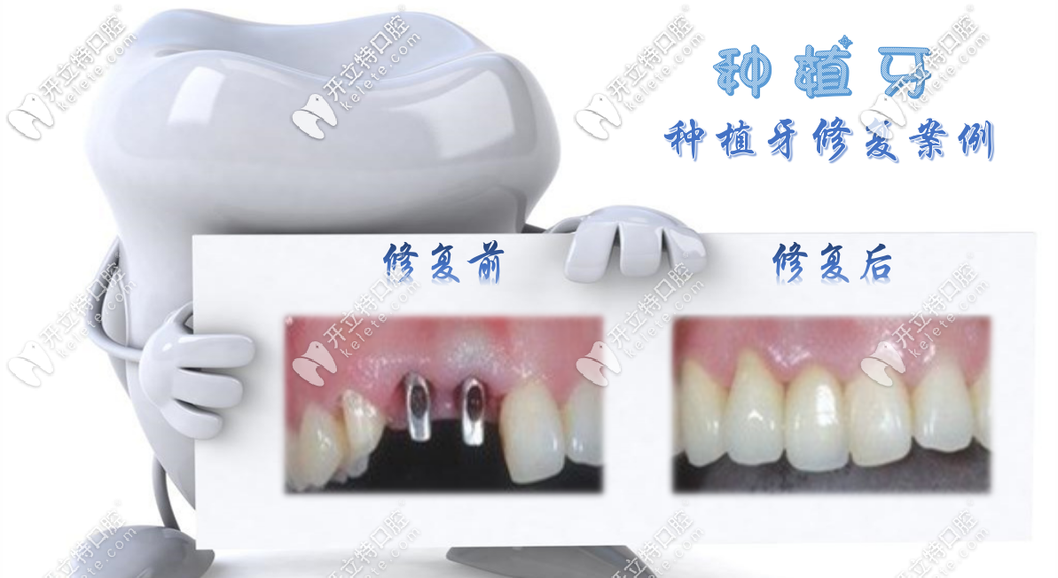 牙齒缺失種植牙修復(fù)案例