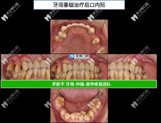 ?55歲重度牙周炎,成功在無錫美奧做了全口即刻負重種植牙