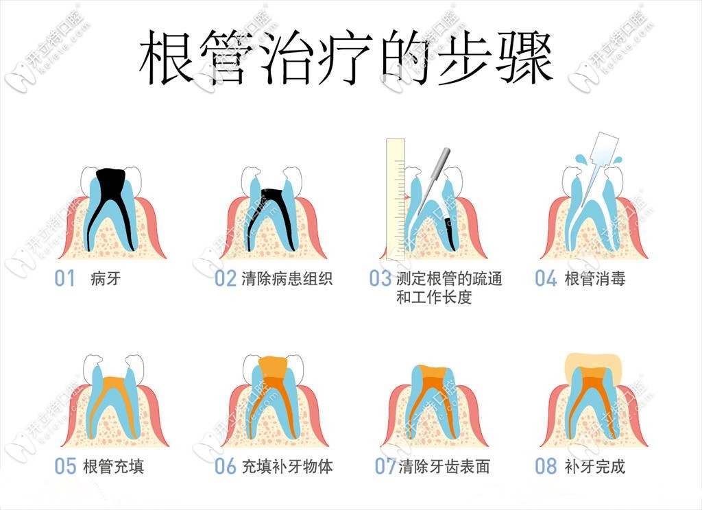 根管治療詳細(xì)過(guò)程