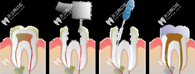 根管治療的過(guò)程