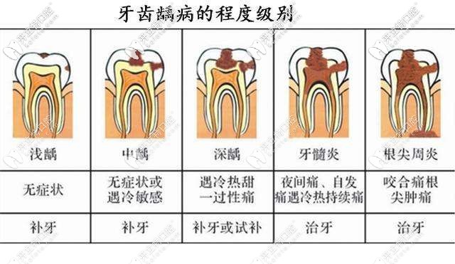 需要做根管的牙齒情況