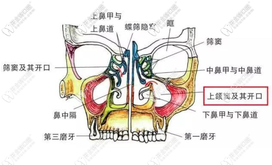 答疑:怎么判斷上頜竇穿孔？種植牙上頜竇穿透了會自愈嗎？