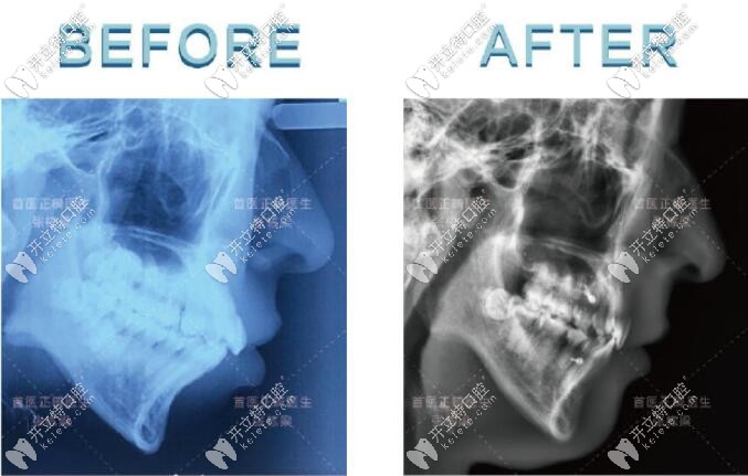 齙牙矯正前后頭顱側(cè)位片前后對比圖
