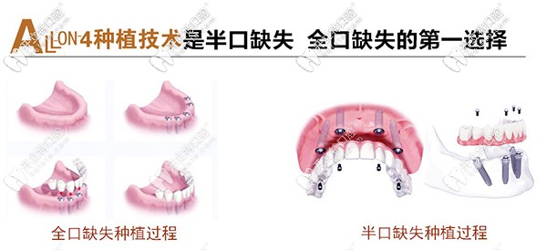 北京市朝陽區(qū)維樂做allon4速導(dǎo)半口種植牙價格是多少？