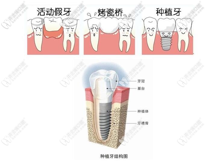 種植牙的結(jié)構(gòu)