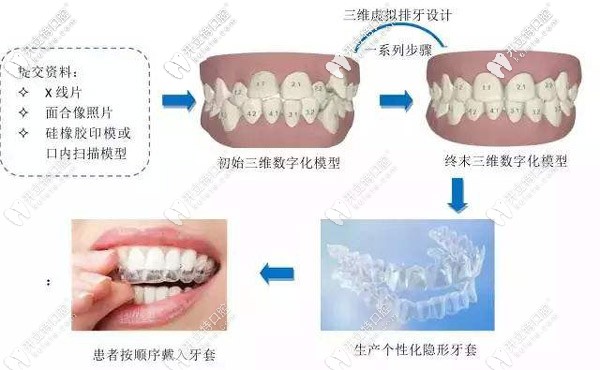 做隱形牙套的面診流程