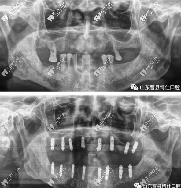 曹縣博仕口腔記錄在菏澤曹縣做滿(mǎn)口即刻種植牙的經(jīng)歷,附種牙價(jià)格表