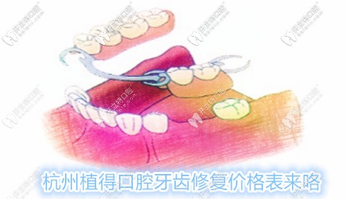 杭州植得口腔鑲牙費(fèi)用表來咯,各種活動義齒的修復(fù)價(jià)格都有