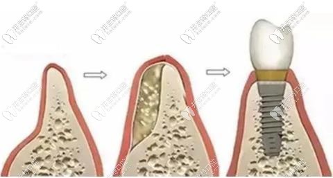 牙槽骨植入骨粉