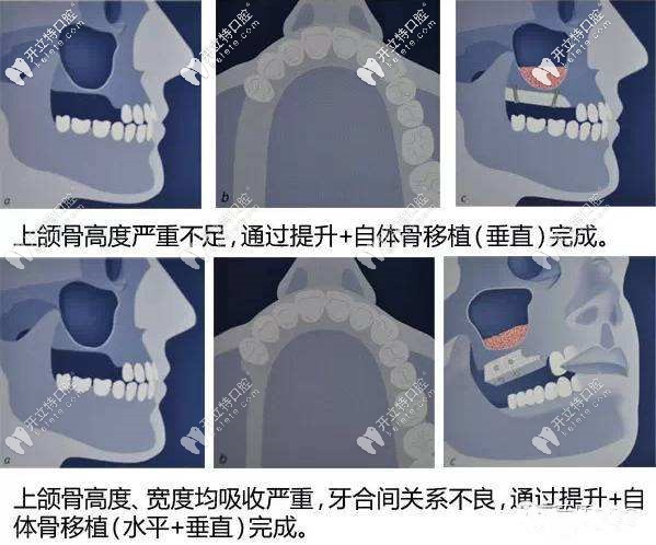 上頜竇內(nèi)外提升圖片